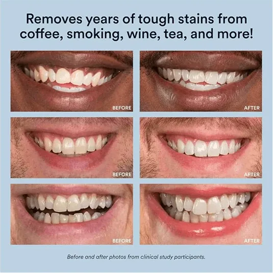 Auraglow Teeth Whitening Kit before and after photos from clinical study participants